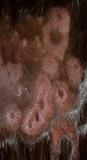 skin lesions