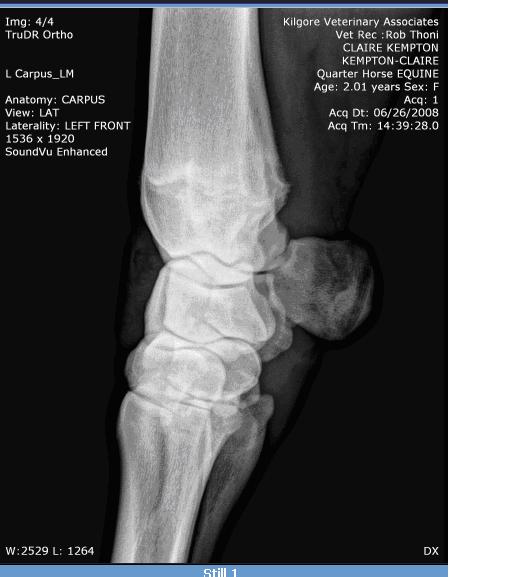 Left Knee (no bone spurs)