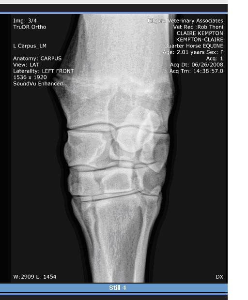 Left Knee-- no bone spurs