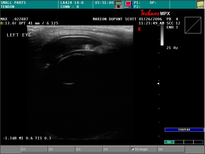 Ultrasound of Left Eye